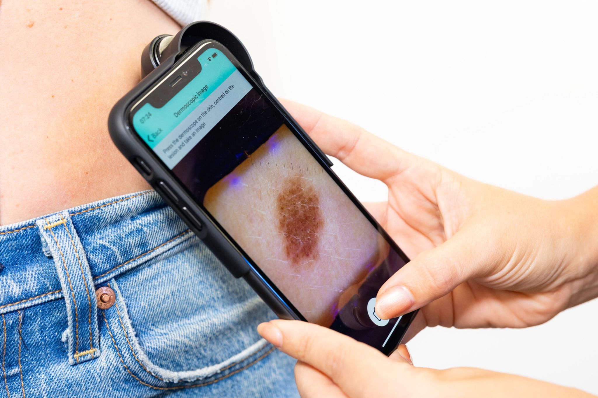 Person using a smartphone with a skin imaging device to scan a mole.